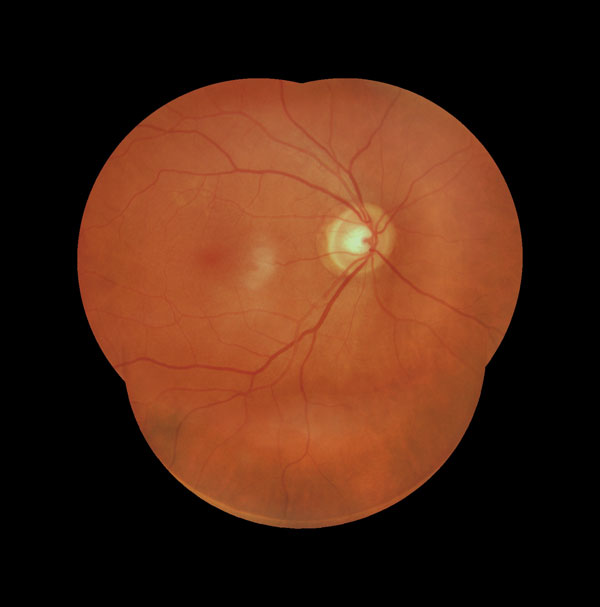RetinaStation retinal image showing the optic disc and surrounding retina